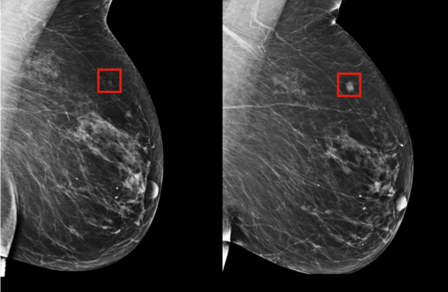 Breast cancer Diagnostics Full Modeling [Ref: TT10040]